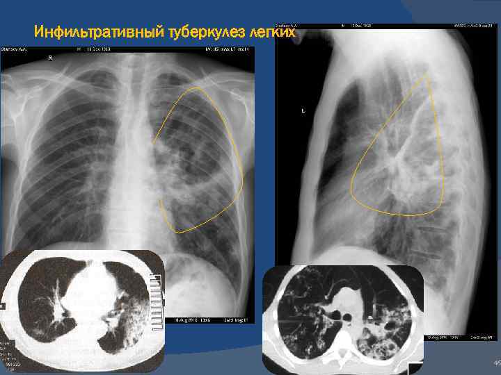 Инфильтративный туберкулез. Инфильтративный ТБС легких. Инфильтративный туберкулез рентген. Инфильтративный туберкулез РЕН. Инфильтративный туберкулез легких рентген.
