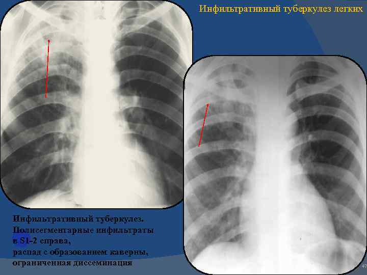 Изменения в верхней доле легкого. Инфильтративный туберкулез легкого с1-2. Инфильтративный туберкулез рентген. Инфильтративный туберкулез s1-2 левого легкого. Инфильтративный туберкулез легких s2.