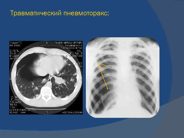 Пневмоторакс лучевая диагностика презентация