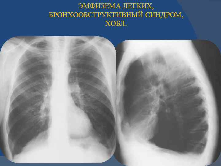 Эмфизема хронического бронхита. ХОБЛ рентген. Рентген грудной клетки ХОБЛ. Рентгенография органов грудной клетки ХОБЛ. Бронхообструктивный синдром рентген.