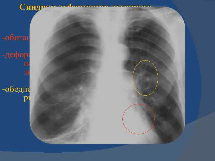 Легочной рисунок деформирован