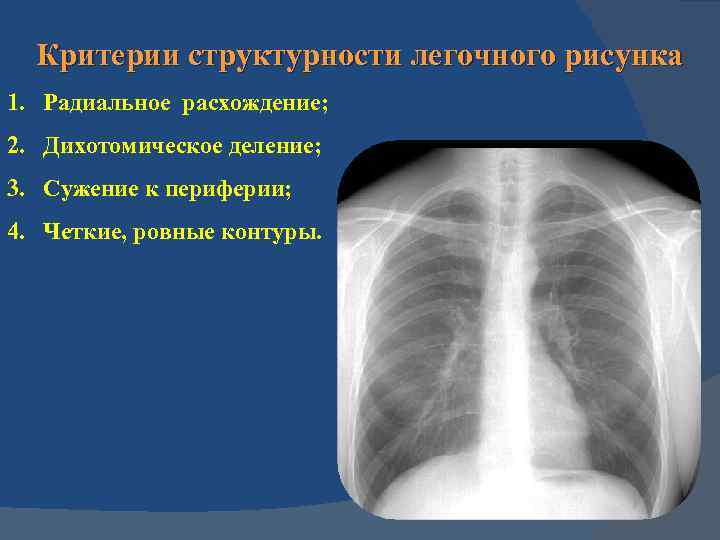 Деформация легочного рисунка