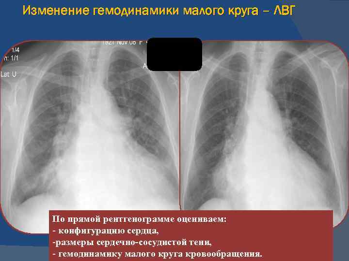 Изменение гемодинамики малого круга – ЛВГ По прямой рентгенограмме оцениваем: - конфигурацию сердца, -размеры
