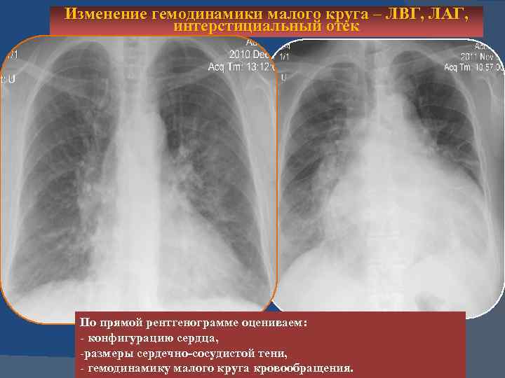 Изменение гемодинамики малого круга – ЛВГ, ЛАГ, интерстициальный отек По прямой рентгенограмме оцениваем: -