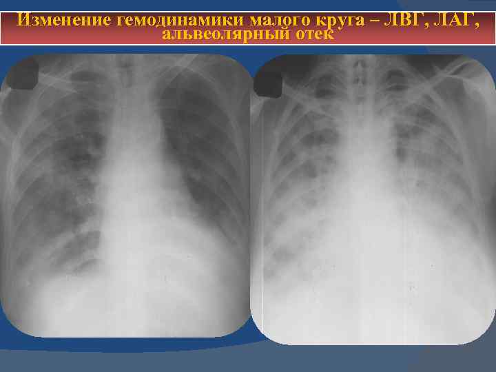 Изменение гемодинамики малого круга – ЛВГ, ЛАГ, альвеолярный отек 