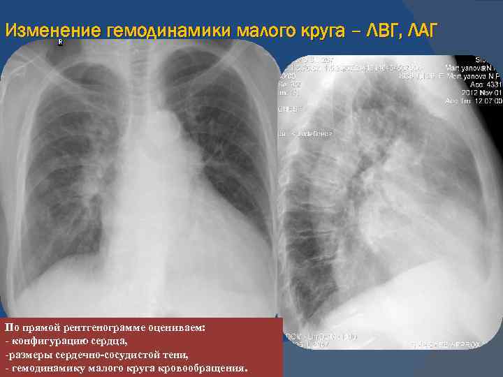 Изменение гемодинамики малого круга – ЛВГ, ЛАГ По прямой рентгенограмме оцениваем: - конфигурацию сердца,