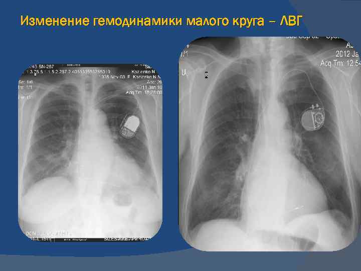 Изменение гемодинамики малого круга – ЛВГ 