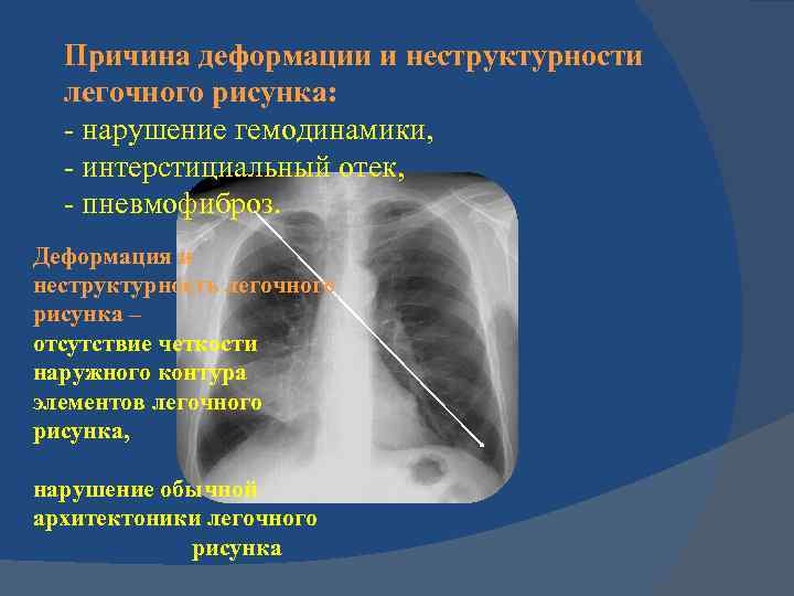 Обогащение легочного рисунка. Легочный рисунок деформирован. Деформация легочного рисунка. Деформация легочного рисунка причины. Легочный рисунок усилен деформирован.