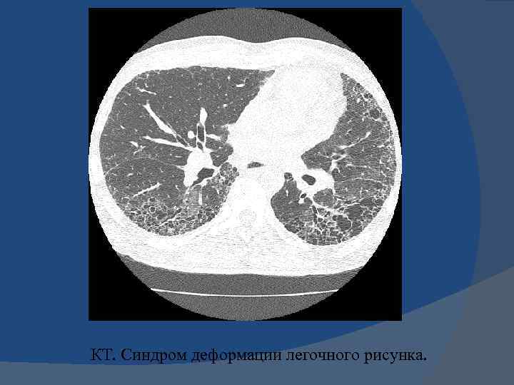 Сосудистый рисунок деформирован