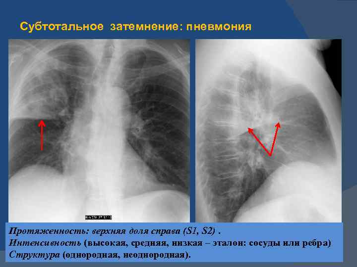 Пневмония в правом легком в нижней доле. Тотальная правосторонняя пневмония рентген. Внебольничная правосторонняя субтотальная пневмония. Субтотальная пневмония справа. Двусторонняя субтотальная пневмония.