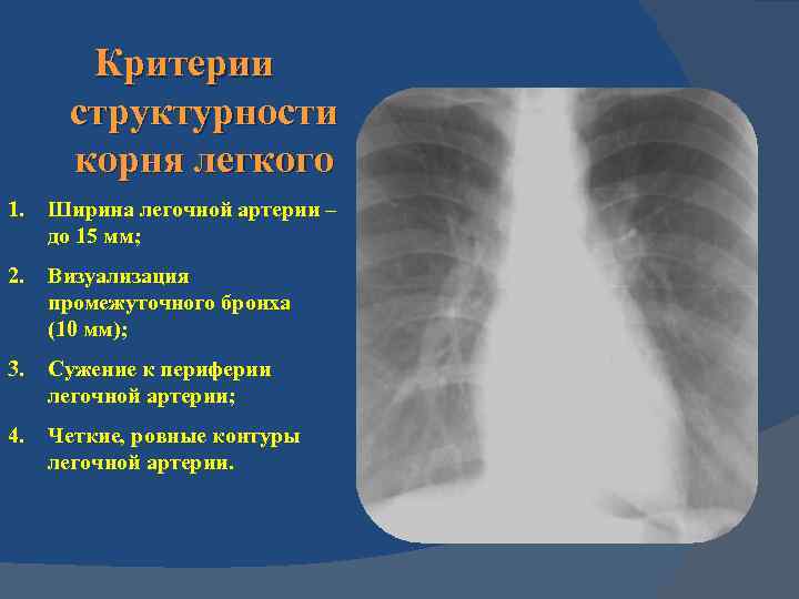 Критерии структурности корня легкого 1. Ширина легочной артерии – до 15 мм; 2. Визуализация