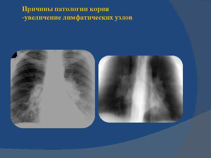 Причины патологии корня -увеличение лимфатических узлов 
