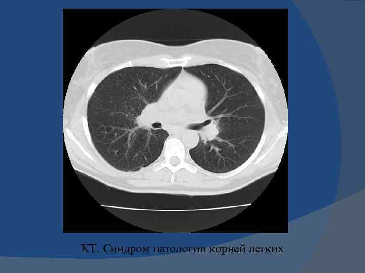 КТ. Синдром патологии корней легких 