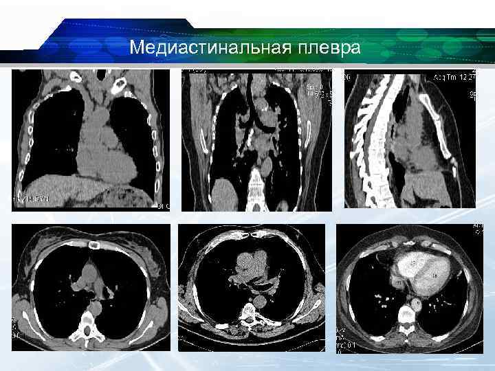 Где находится плевра фото