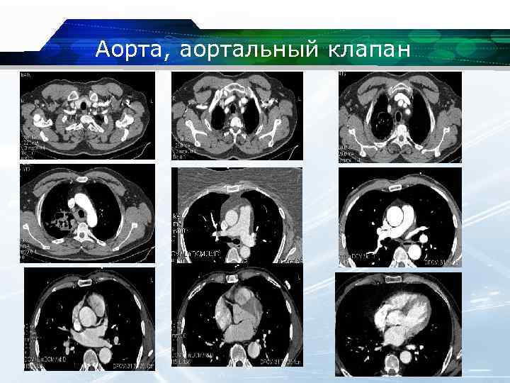 Двустворчатый аортальный клапан симптомы