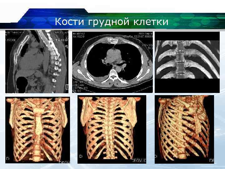 Кт костей скелета. Кт ребер грудной клетки. Кт снимок грудной клетки. Кт костей грудной клетки.