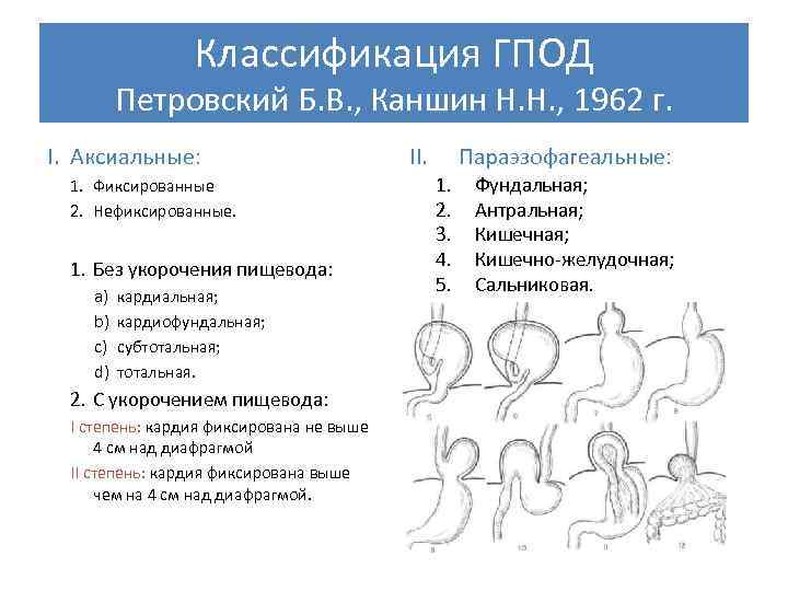 Грыжа кардиального отверстия диафрагмы. Грыжи диафрагмы классификация Петровского. Аксиальные грыжи пищеводного отверстия диафрагмы классификация. Классификация Петровского грыжи пищеводного отверстия диафрагмы. Классификация ГПОД (Б.В. Петровский и н.н. Каншин, 1966г.).