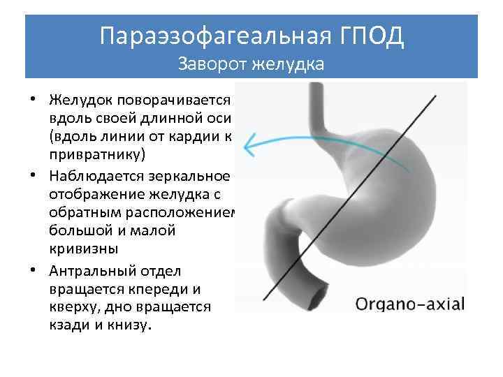 Что такое грыжа пищеводного отверстия диафрагмы