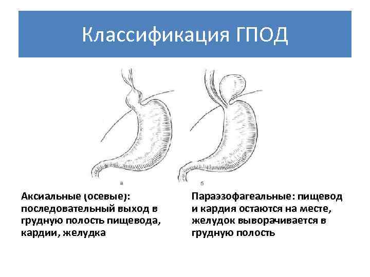 Пищеводного отдела диафрагмы