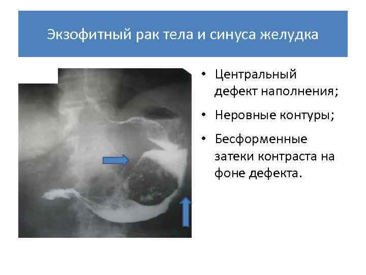 Рак жкт презентация