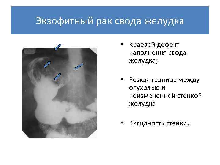 Экзофитный рост опухоли рисунок