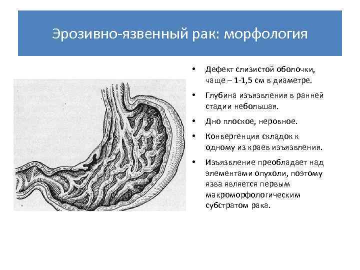 Эрозивно-язвенный рак: морфология • Дефект слизистой оболочки, чаще – 1 -1, 5 см в