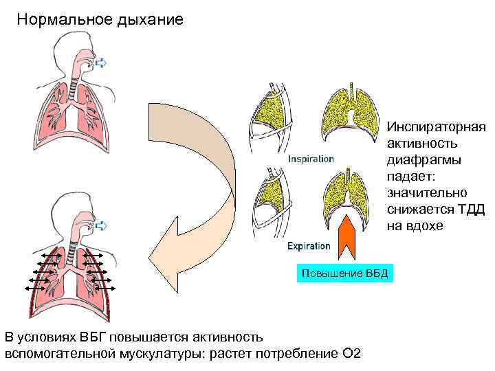 Нормальное дыхание Инспираторная активность диафрагмы падает: значительно снижается ТДД на вдохе Повышение ВБД В