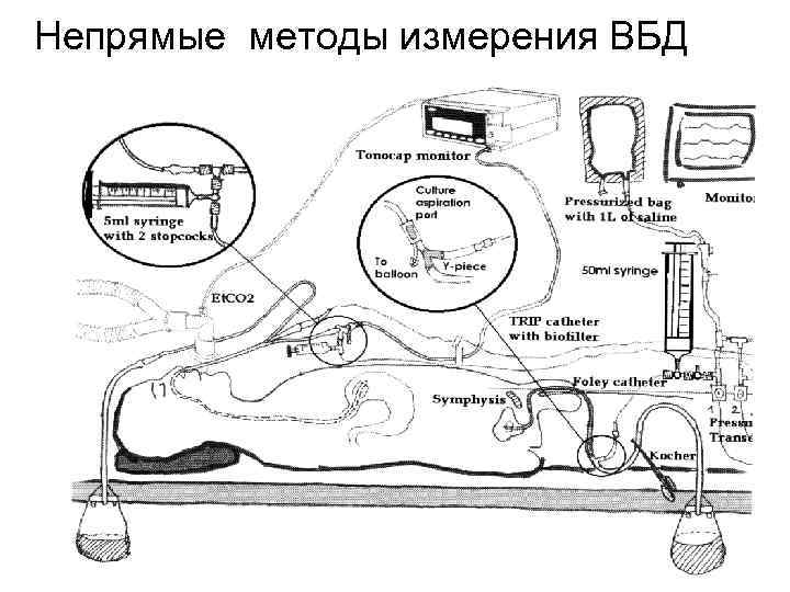 Непрямые методы измерения ВБД 