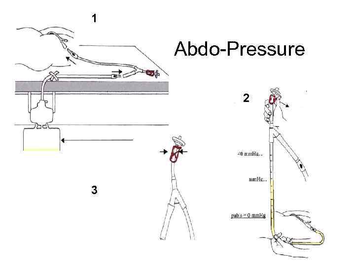 1 Abdo-Pressure 2 3 
