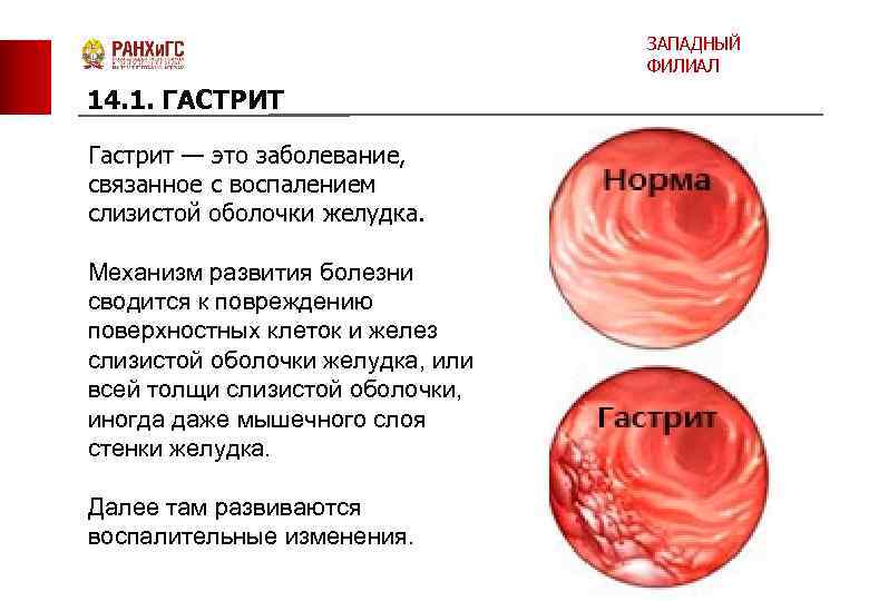 ЗАПАДНЫЙ ФИЛИАЛ 14. 1. ГАСТРИТ Гастрит — это заболевание, связанное с воспалением слизистой оболочки