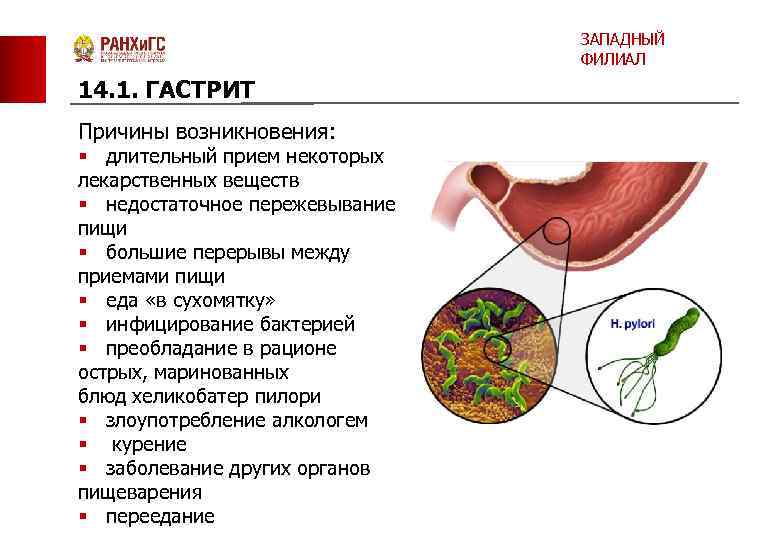 ЗАПАДНЫЙ ФИЛИАЛ 14. 1. ГАСТРИТ Причины возникновения: § длительный прием некоторых лекарственных веществ §