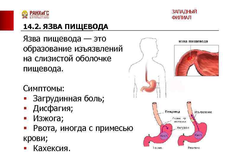 ЗАПАДНЫЙ ФИЛИАЛ 14. 2. ЯЗВА ПИЩЕВОДА Язва пищевода — это образование изъязвлений на слизистой