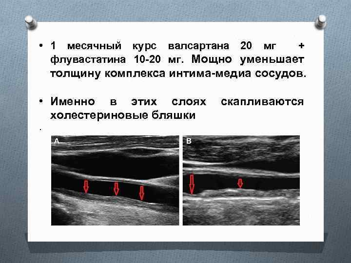  • 1 месячный курс валсартана 20 мг + флувастатина 10 -20 мг. Мощно