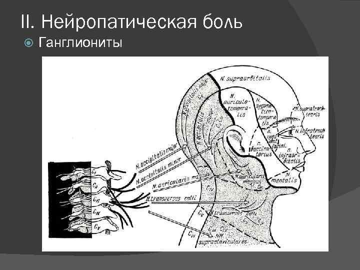 II. Нейропатическая боль Ганглиониты 