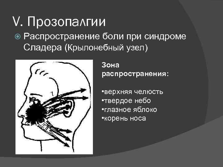 V. Прозопалгии Распространение боли при синдроме Сладера (Крылонебный узел) Зона распространения: • верхняя челюсть