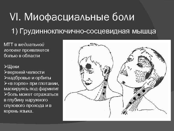 VI. Миофасциальные боли 1) Грудинноключично-сосцевидная мышца МТТ в медиальной головке проявляется болью в области