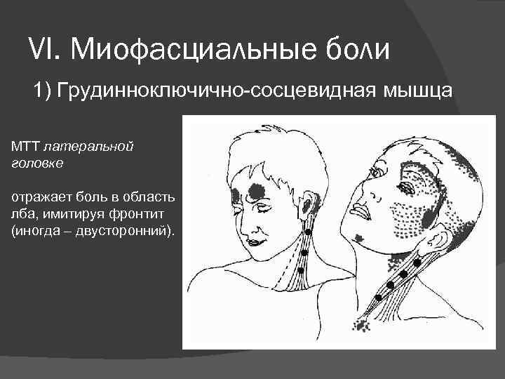 VI. Миофасциальные боли 1) Грудинноключично-сосцевидная мышца МТТ латеральной головке отражает боль в область лба,