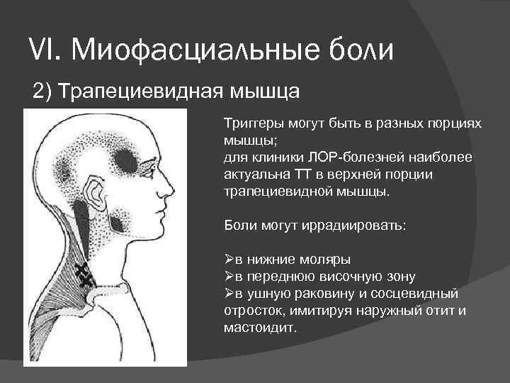 VI. Миофасциальные боли 2) Трапециевидная мышца Триггеры могут быть в разных порциях мышцы; для