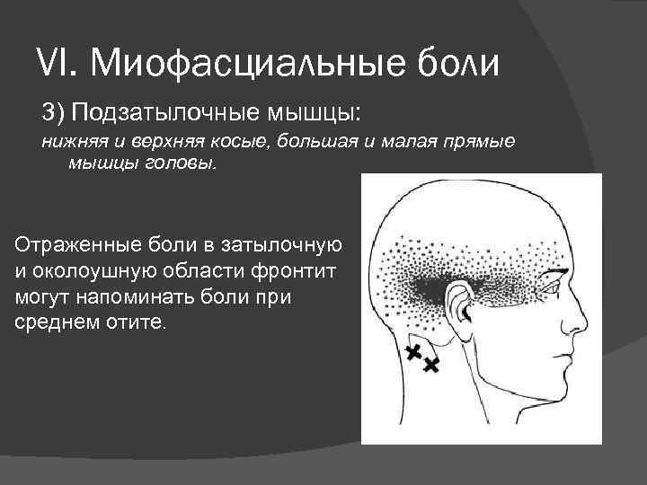 VI. Миофасциальные боли 3) Подзатылочные мышцы: нижняя и верхняя косые, большая и малая прямые
