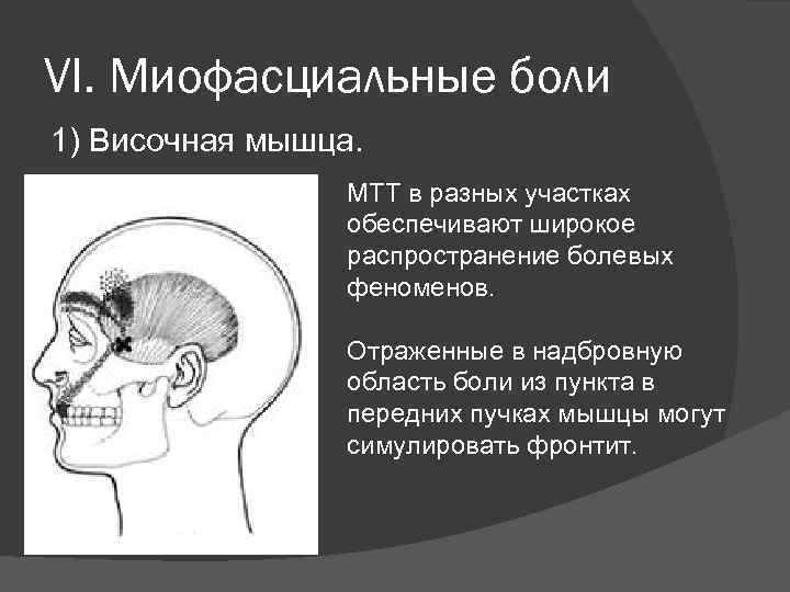 VI. Миофасциальные боли 1) Височная мышца. МТТ в разных участках обеспечивают широкое распространение болевых