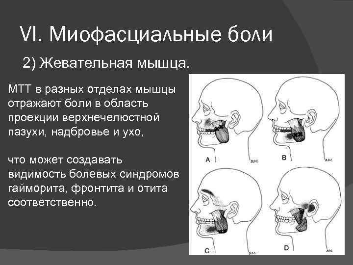 VI. Миофасциальные боли 2) Жевательная мышца. МТТ в разных отделах мышцы отражают боли в