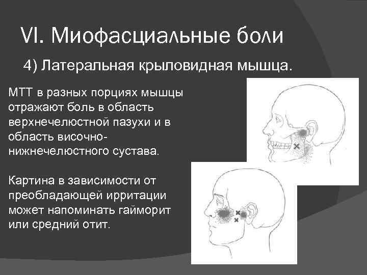VI. Миофасциальные боли 4) Латеральная крыловидная мышца. МТТ в разных порциях мышцы отражают боль