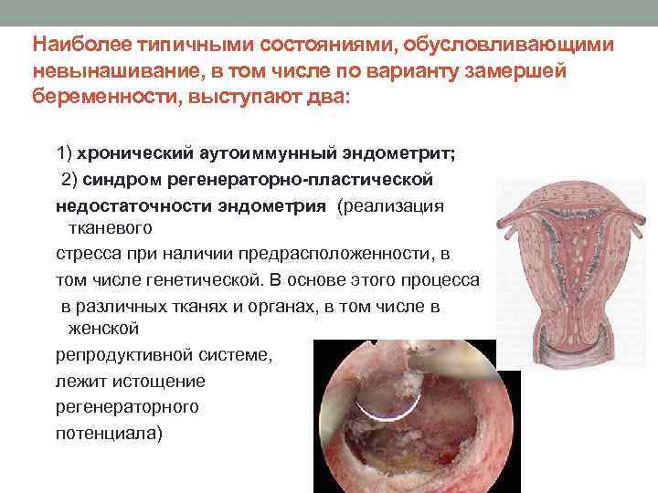 Картинки невынашивания беременности