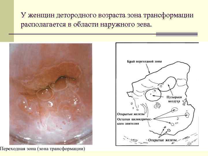 У женщин детородного возраста зона трансформации располагается в области наружного зева. 