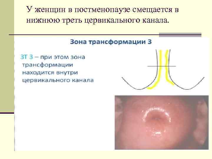 У женщин в постменопаузе смещается в нижнюю треть цервикального канала. 