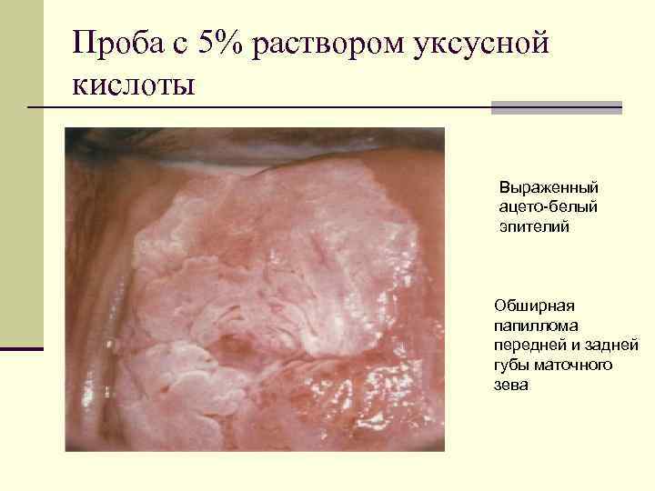 Проба с 5% раствором уксусной кислоты Выраженный ацето-белый эпителий Обширная папиллома передней и задней