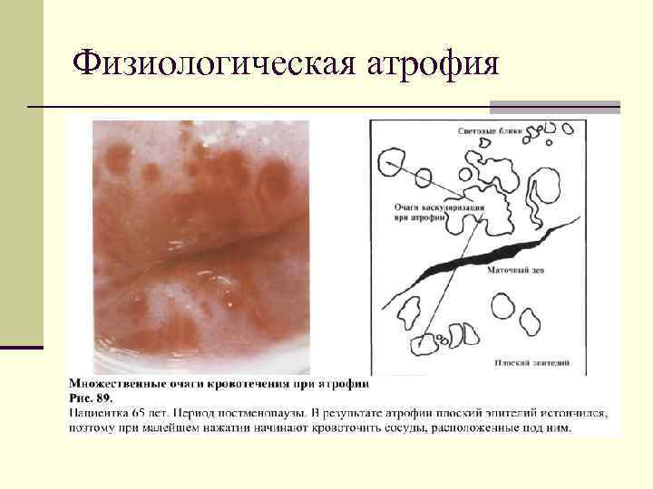 Физиологическая атрофия 