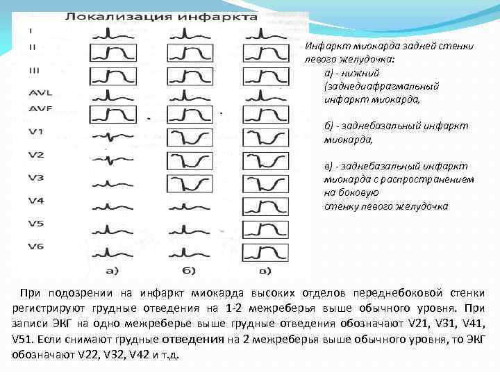 Инфаркт миокарда задней стенки левого желудочка: а) - нижний (заднедиафрагмальный инфаркт миокарда, б) -