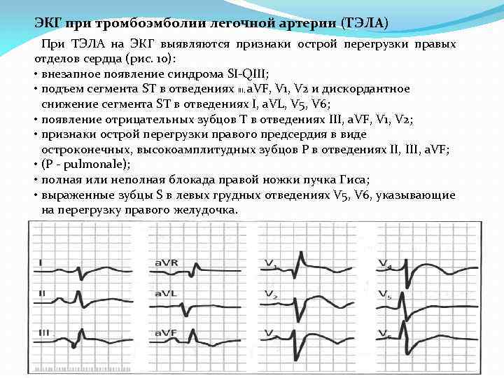 Экг при тэла картинки