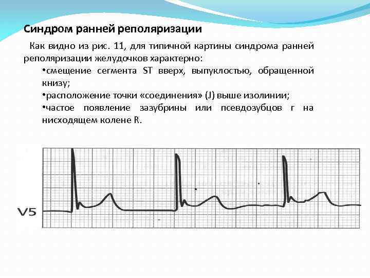 Синдром ранней реполяризации Как видно из рис. 11, для типичной картины синдрома ранней реполяризации